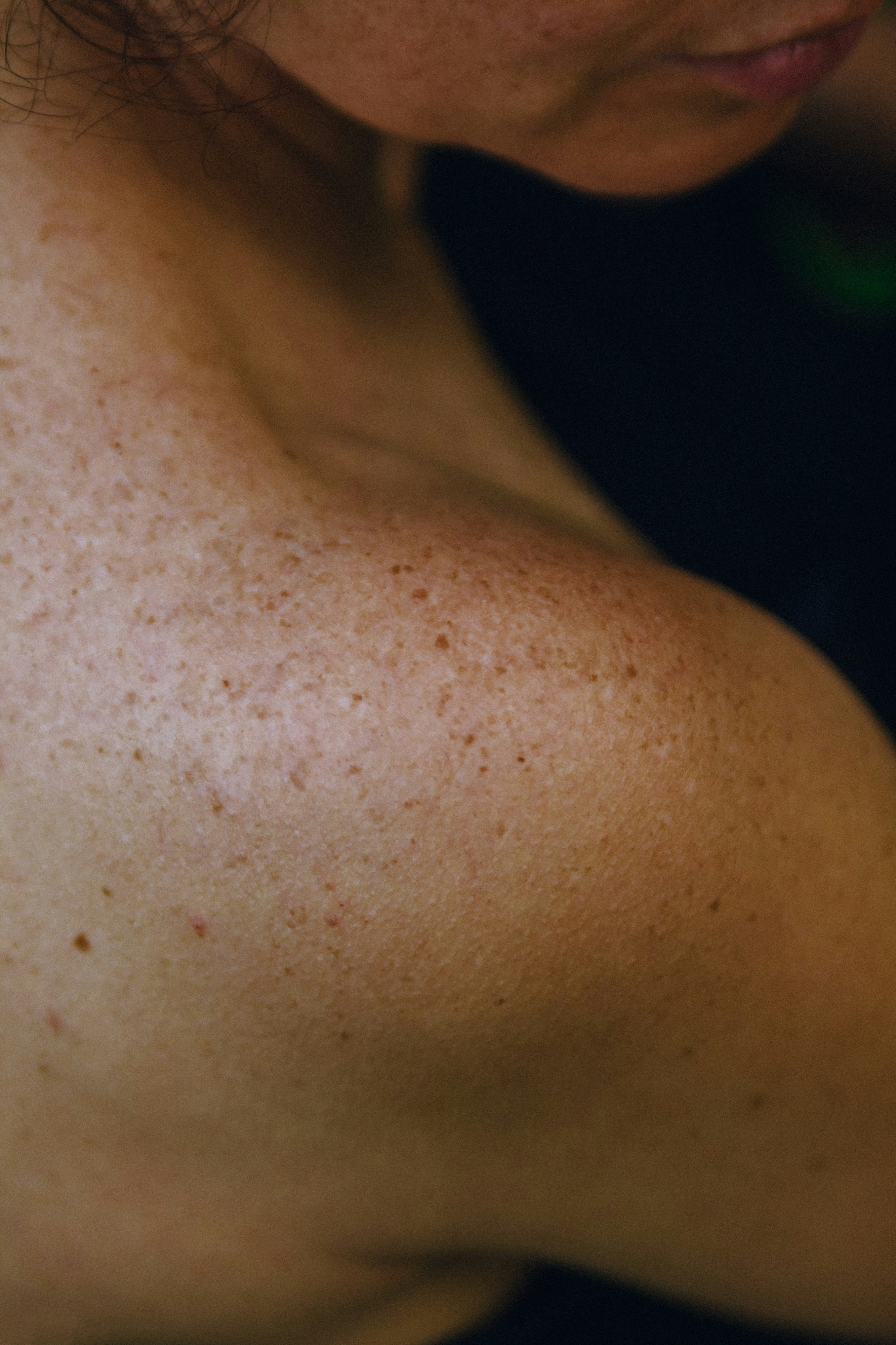 Pigmented Lesions